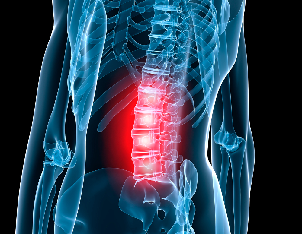 ernia-del-disco ernia-del-disco