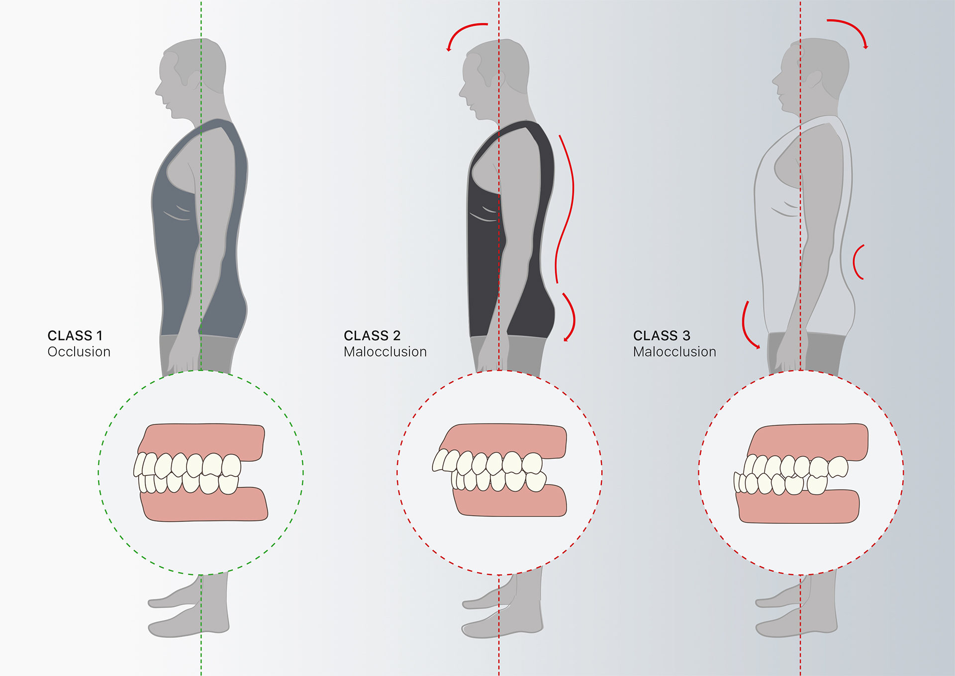 malocclusione_dentale malocclusione_dentale