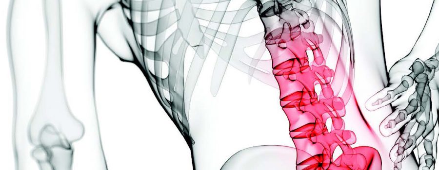 Sindrome delle faccette articolari