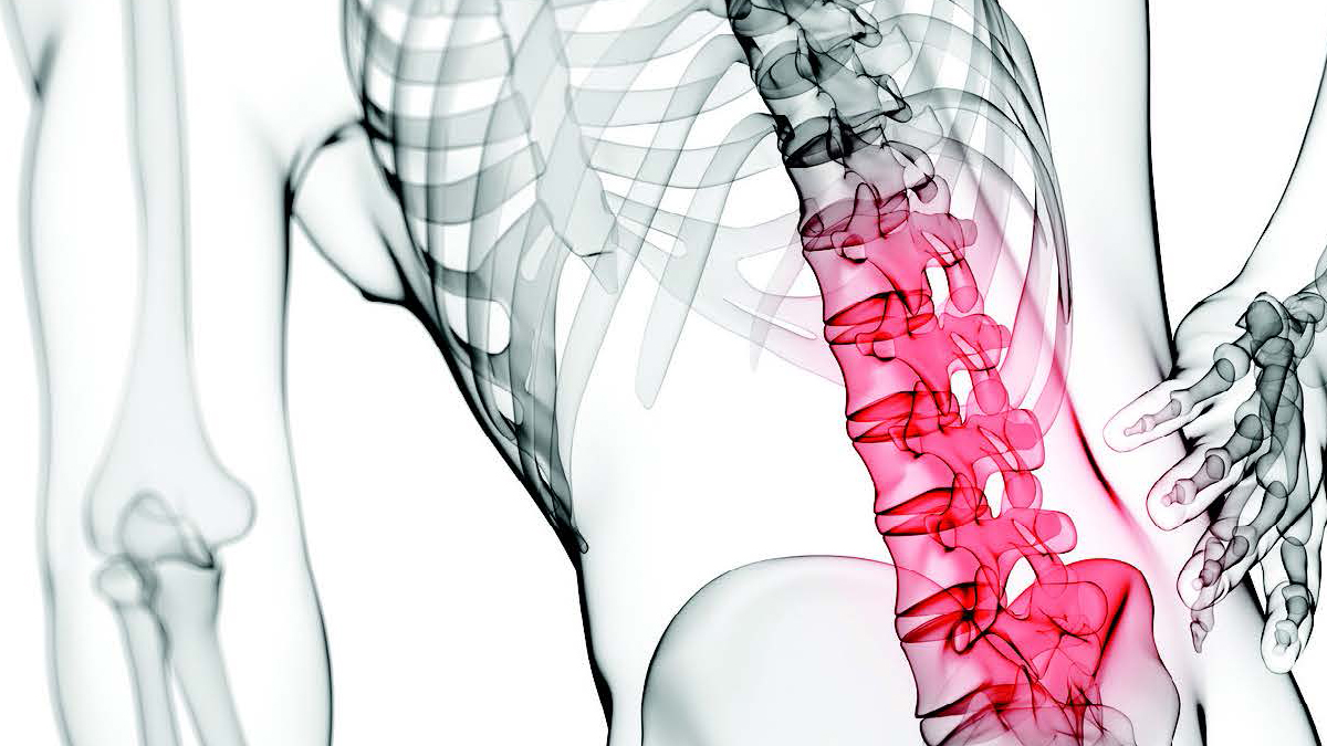 Sindrome delle faccette articolari